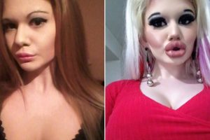 22-vjeçarja rrit buzët trefish, por nuk kënaqet me aq