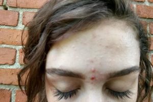 Pse ju shfaqen puçrra vetëm në ball e midis vetullave, trajtimi më efektiv sipas dermatologëve