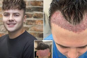 I riu britanik bën transplant për mbjelljen e flokëve në Turqi, rezultati e ‘traumatizon’