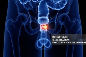 Prostate cancer, computer illustration.