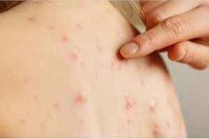 Fruthi, epidemi në SHBA dhe Meksikë. OBSH po shqyrton heqjen e statusit “pa fruth”