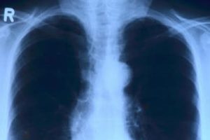 Tumoret po rriten te të rinjtë: në rritje kanceri i kolonit, pankreasit dhe mushkërive